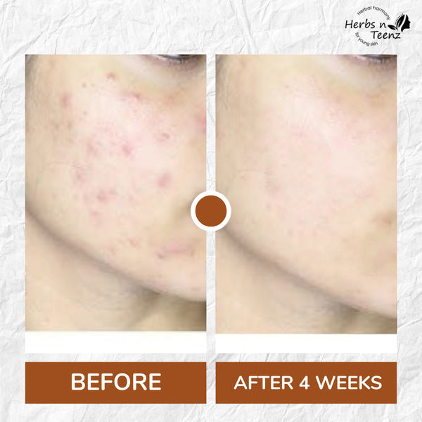 The Acne Starter Kit (Cleanse, Treat, Protect)