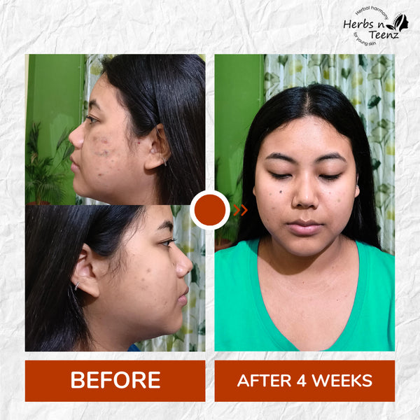 Anti-Acne Gel- 50gm